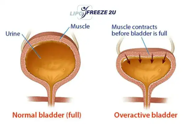 diagram of overactive bladder treatment Sandy
