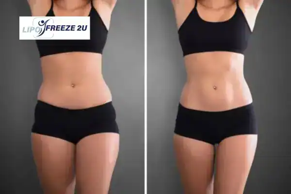How Can LIPO FREEZE 2U Support Your Post-Pregnancy Body Recovery Sandy?