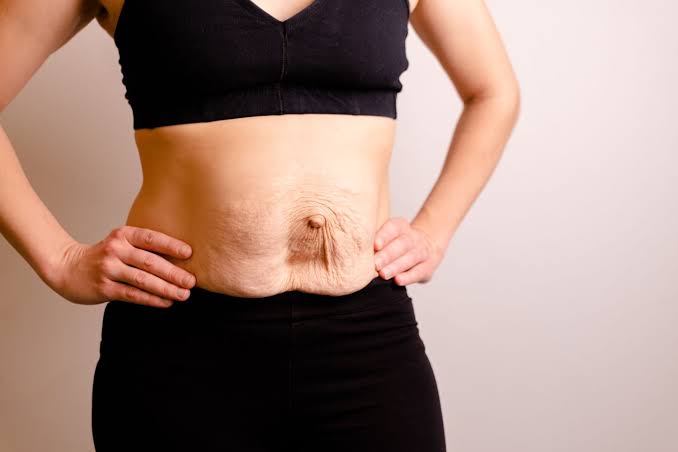 Is Surgery Really the Only Way to Repair Diastasis Recti Sandy?