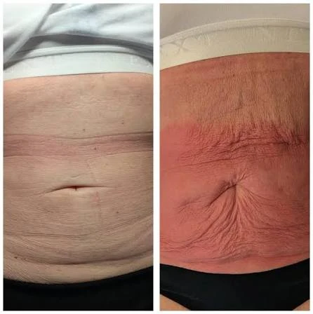 How Does RF Microneedling Improve Crepey, Thin and Uneven Skin Texture Sandy?