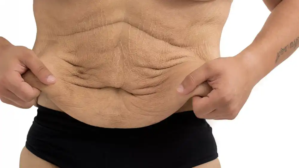 RF Microneedling for Loose Skin: How Can It Help Tighten and Reshape the Skin Sandy?